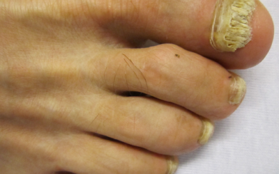 M Maddocks Inc Provides Comprehensive Care for Common Foot Fungal Infections