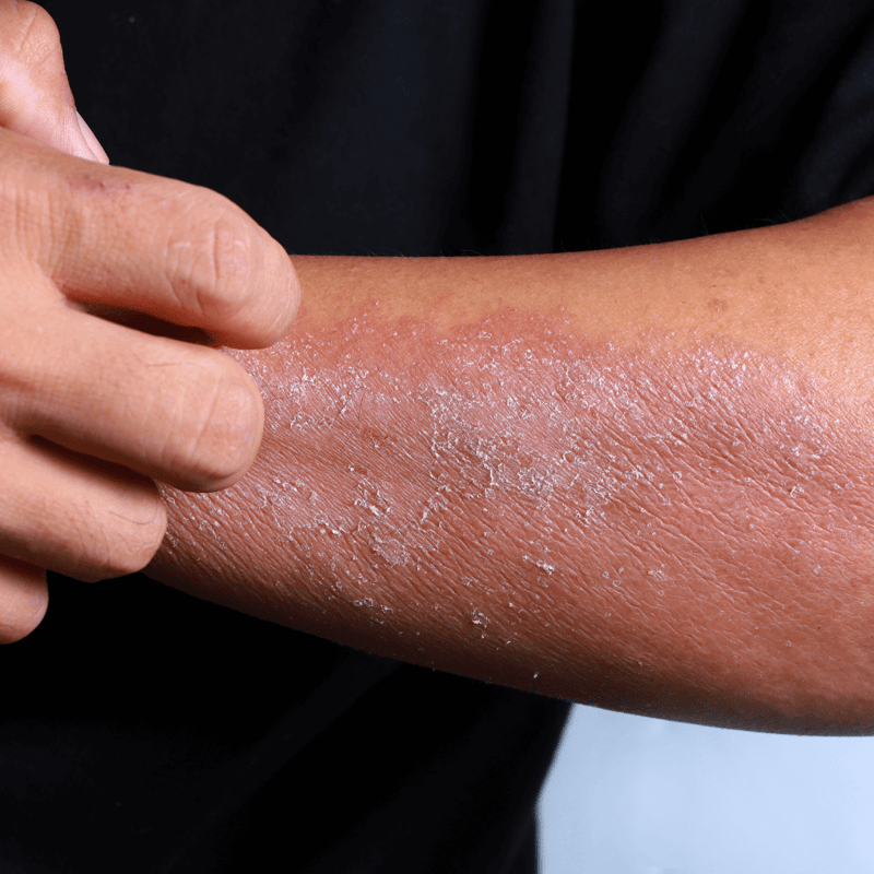 Is it actinic keratosis, or do you just have dry skin?