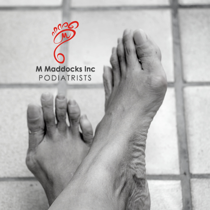 Foot Health Awareness: Understanding and Managing Metatarsalgia with M Maddocks Inc