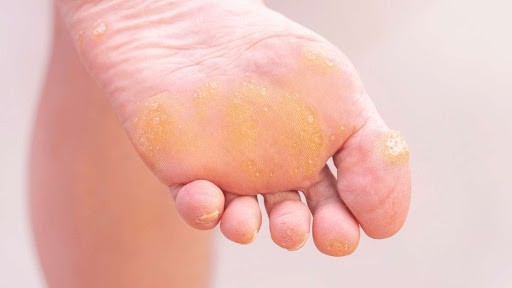 Optimizing Foot Health: Strategies to Prevent Callus Recurrence