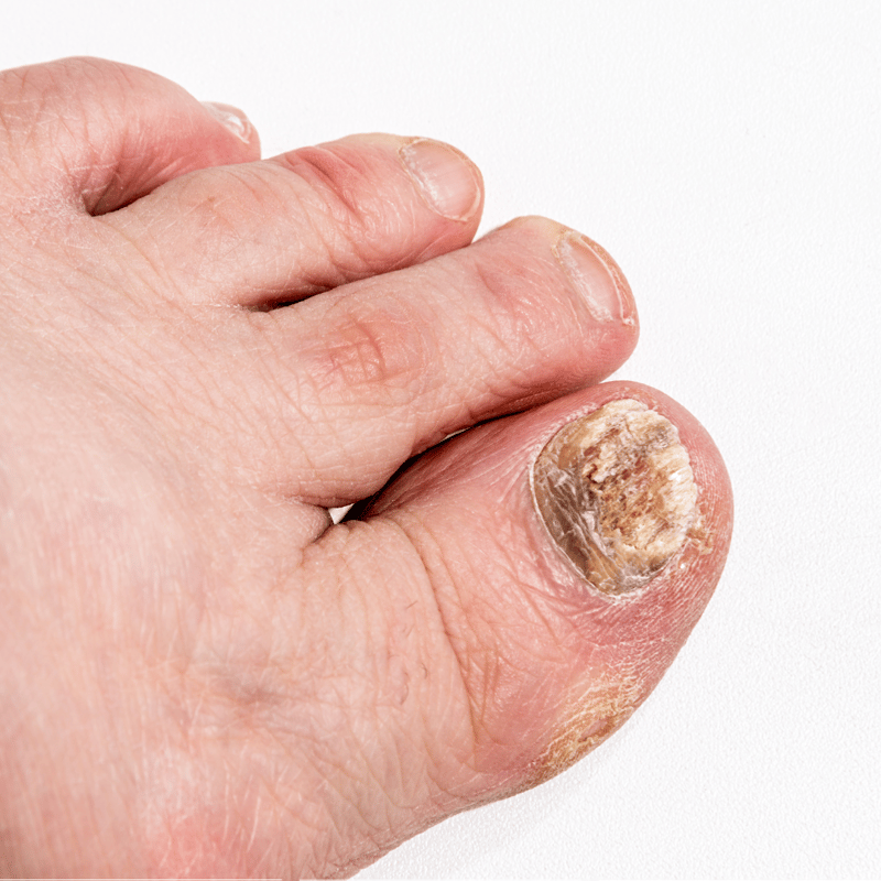 Addressing Nail Fungus: A Crucial Step Towards Healthier Feet