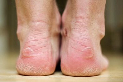 Understanding and Preventing Foot Blisters from M Maddocks Inc