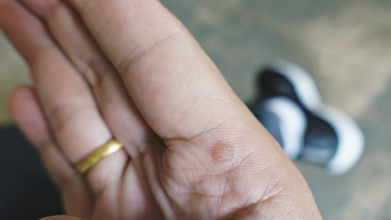 3 Reasons Children Are More Prone to Warts… and How to Treat Them!