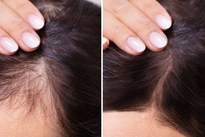 Effective Solutions for Hair Loss