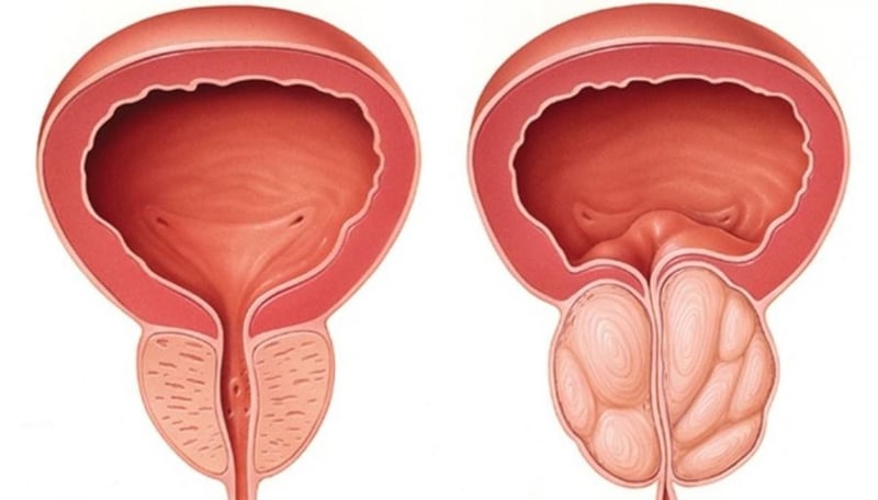 New Non-Surgical Procedure Available For Prostate Enlargement Approved For Widespread Treatment Through The UK’s National Health Service