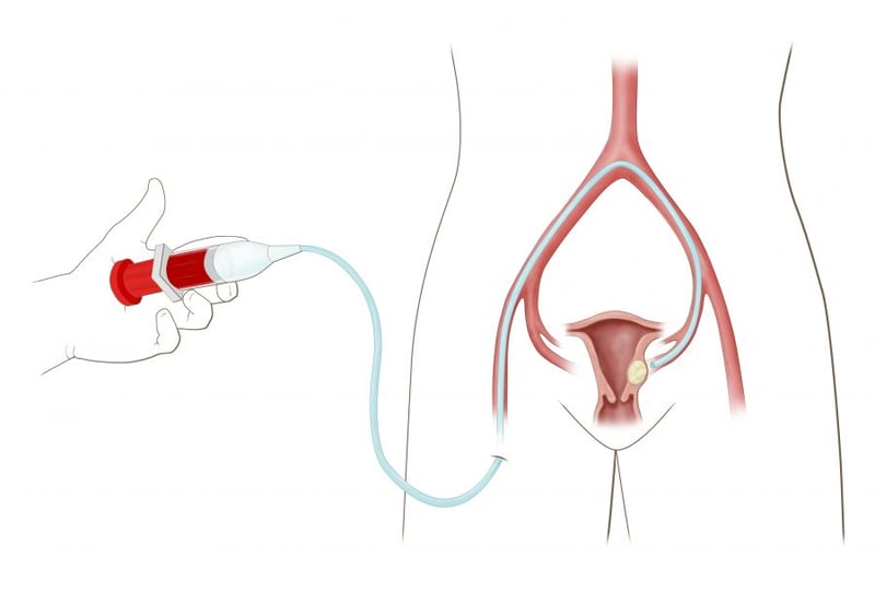 Avoid a Hysterectomy with Fibroid Embolisation