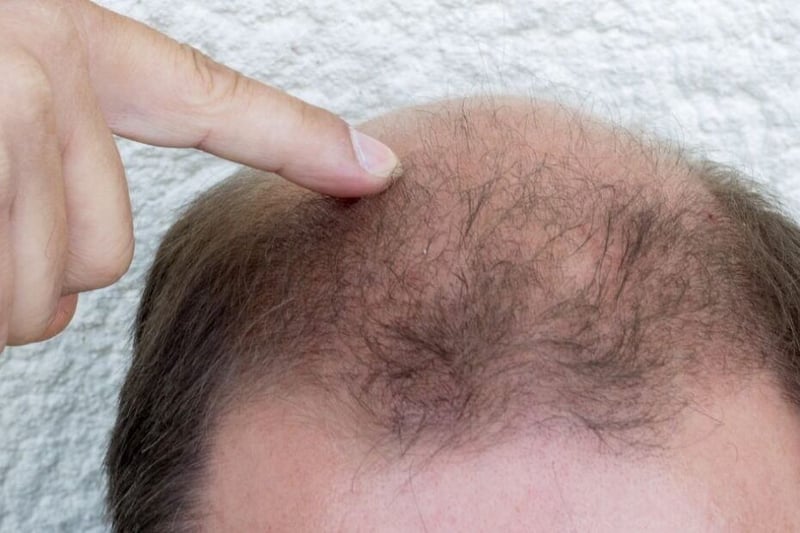 Hair Procedures That Help With Thinning and Balding