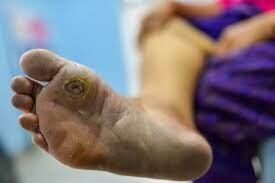 Expert Insights on Diabetic Foot Ulcers - Prevention and Management Tips from M Maddocks Inc