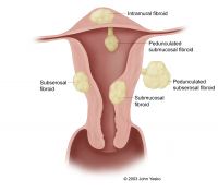 Uterine Fibroid Embolisation